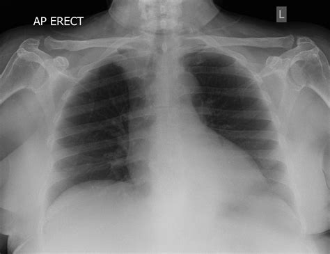 ap lordotic chest x ray.